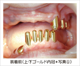装着前(上・下ゴールド内冠*写真@) 装着前(上・下ゴールド内冠*写真@)