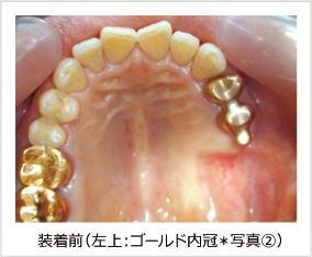 装着前(上・下ゴールド内冠*写真A) 装着前(上・下ゴールド内冠*写真A)
