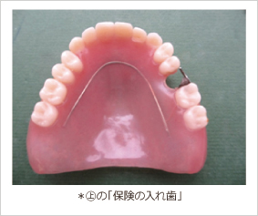 上の保険の入れ歯 上の保険の入れ歯