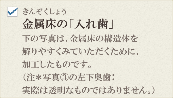 金属床の「入れ歯」 金属床の「入れ歯」