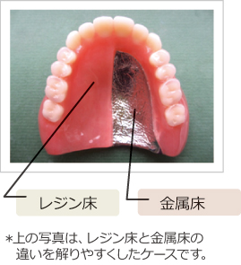 総入れ歯 総入れ歯