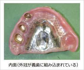 レジリエンツテレスコープ(内面) レジリエンツテレスコープ(内面)