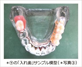 ��の「入れ歯」サンプル模型（＊写真�B）