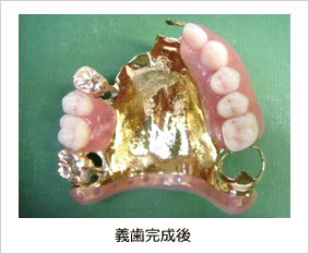 義歯完成後 義歯完成後
