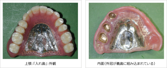 入れ歯 入れ歯