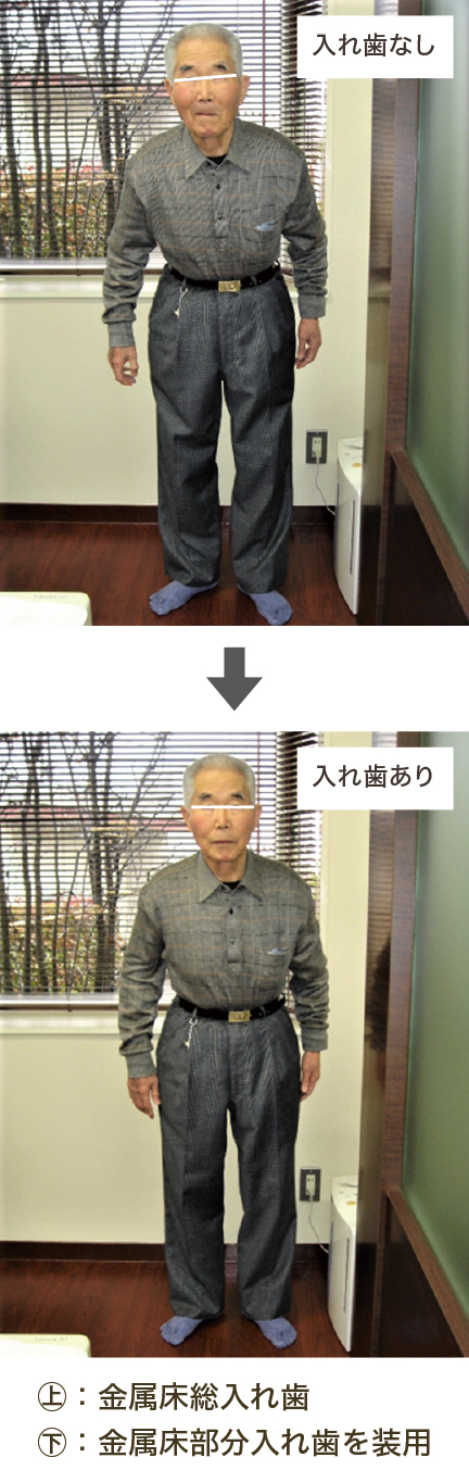 入れ歯あり・入れ歯なし 入れ歯あり・入れ歯なし